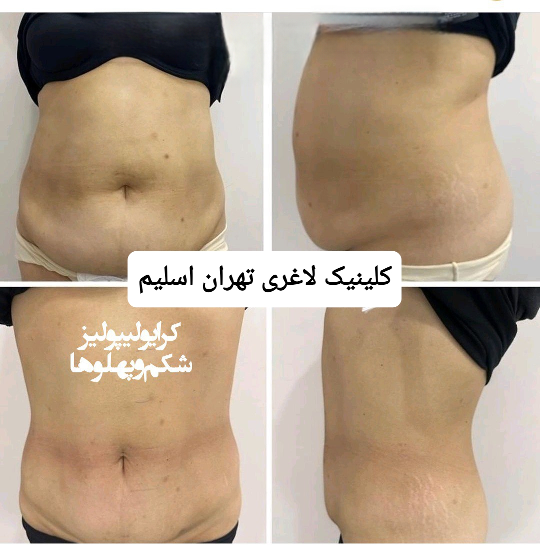 کلینیک لاغری تهران اسلیم
