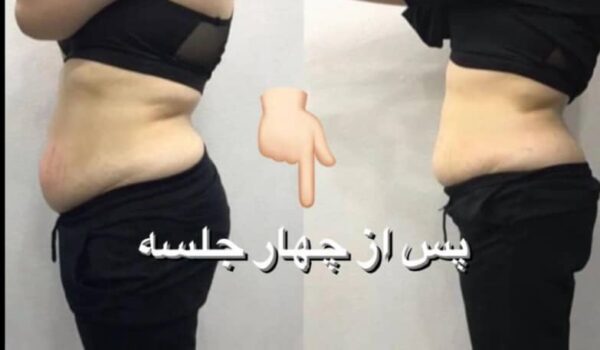 لاغری موضعی در تهران