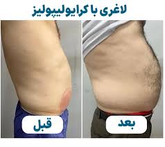 آیا کرایولیپولیز عوارض دارد؟